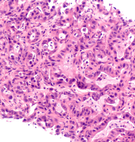 Microscopic image of core biopsy of liver showing metastatic can